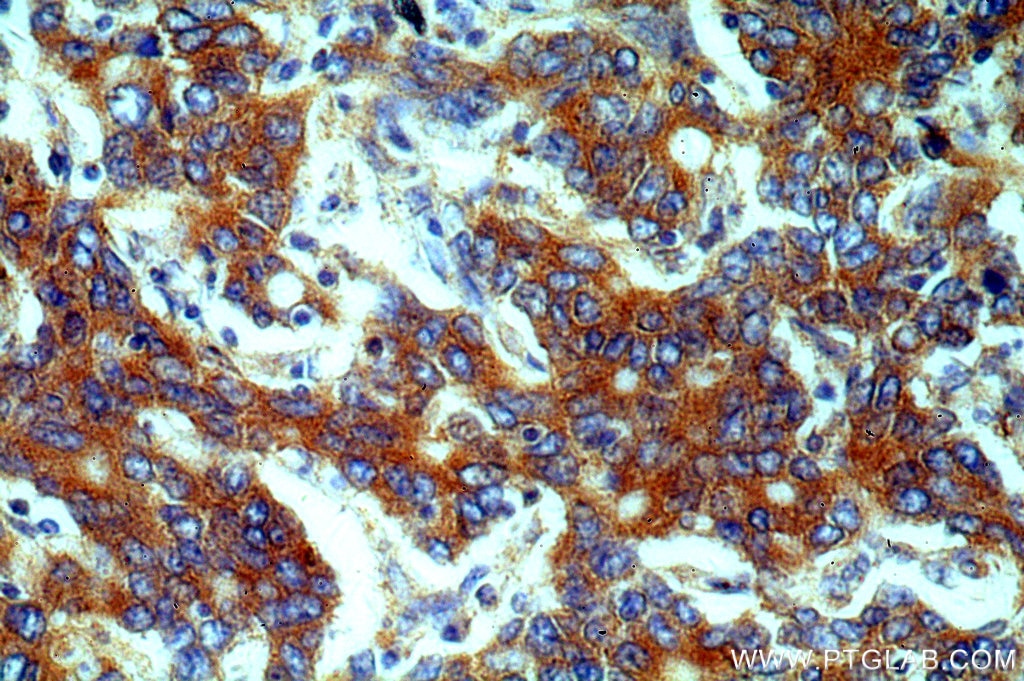Immunohistochemistry (IHC) staining of human stomach cancer tissue using EEF2 Polyclonal antibody (20107-1-AP)
