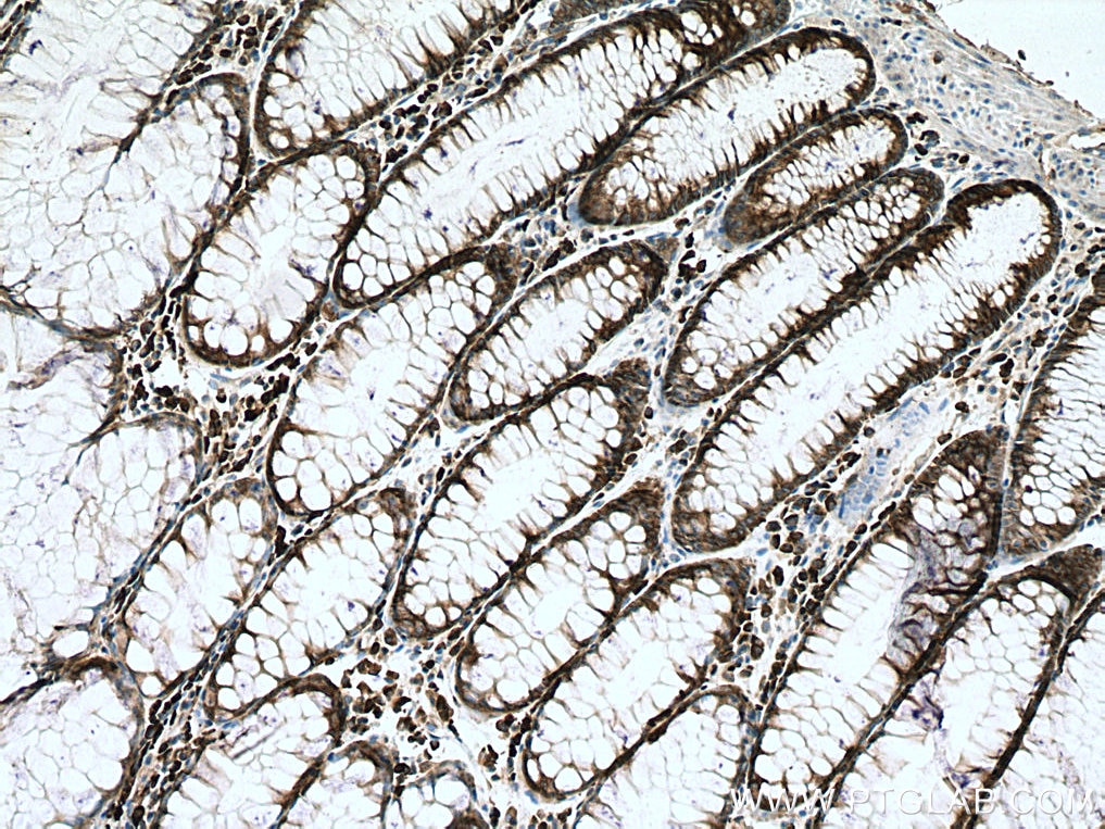 IHC staining of human colon cancer using 67550-1-Ig