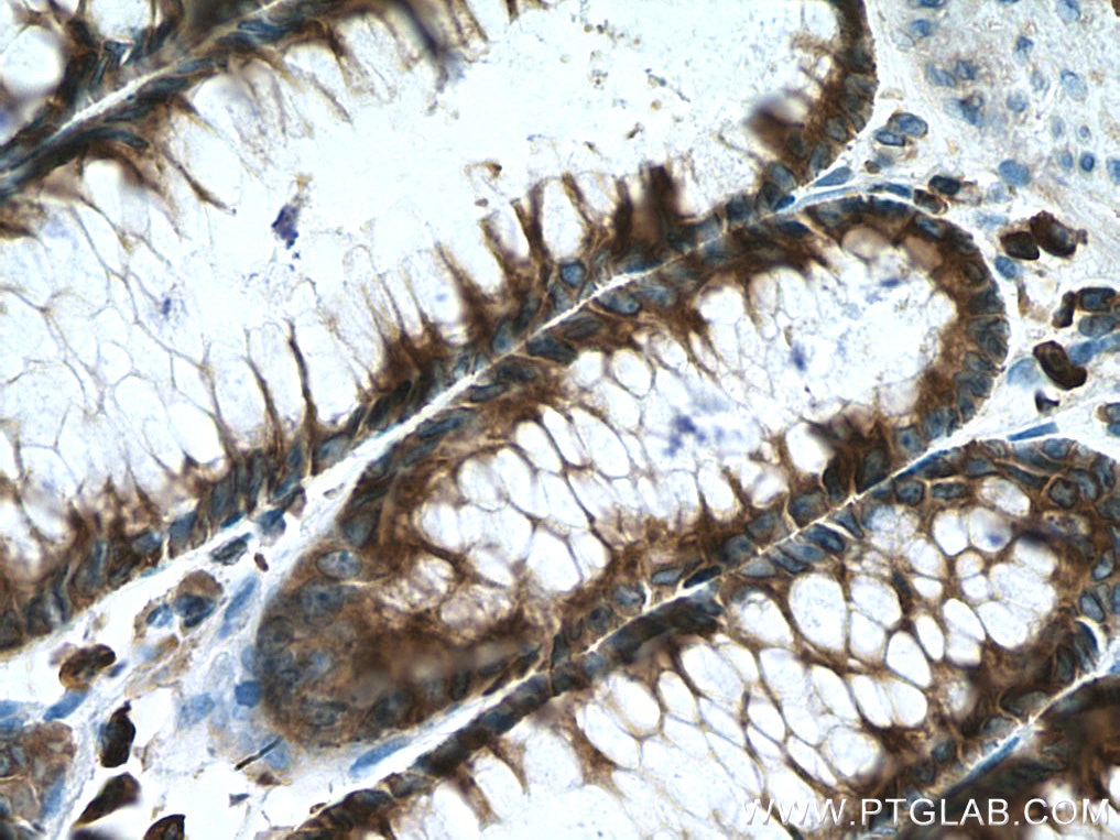 Immunohistochemistry (IHC) staining of human colon cancer tissue using EEF2 Monoclonal antibody (67550-1-Ig)