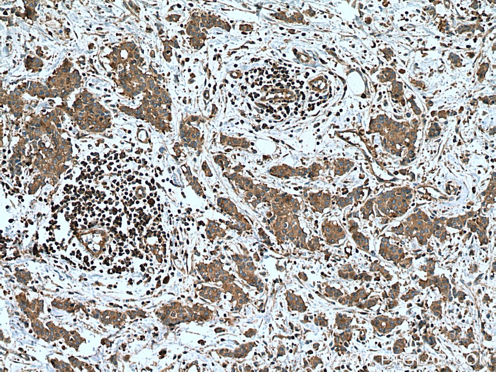 Immunohistochemistry (IHC) staining of human breast cancer tissue using EEF2 Monoclonal antibody (67550-1-Ig)