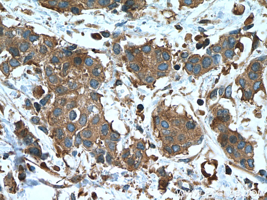 Immunohistochemistry (IHC) staining of human breast cancer tissue using EEF2 Monoclonal antibody (67550-1-Ig)