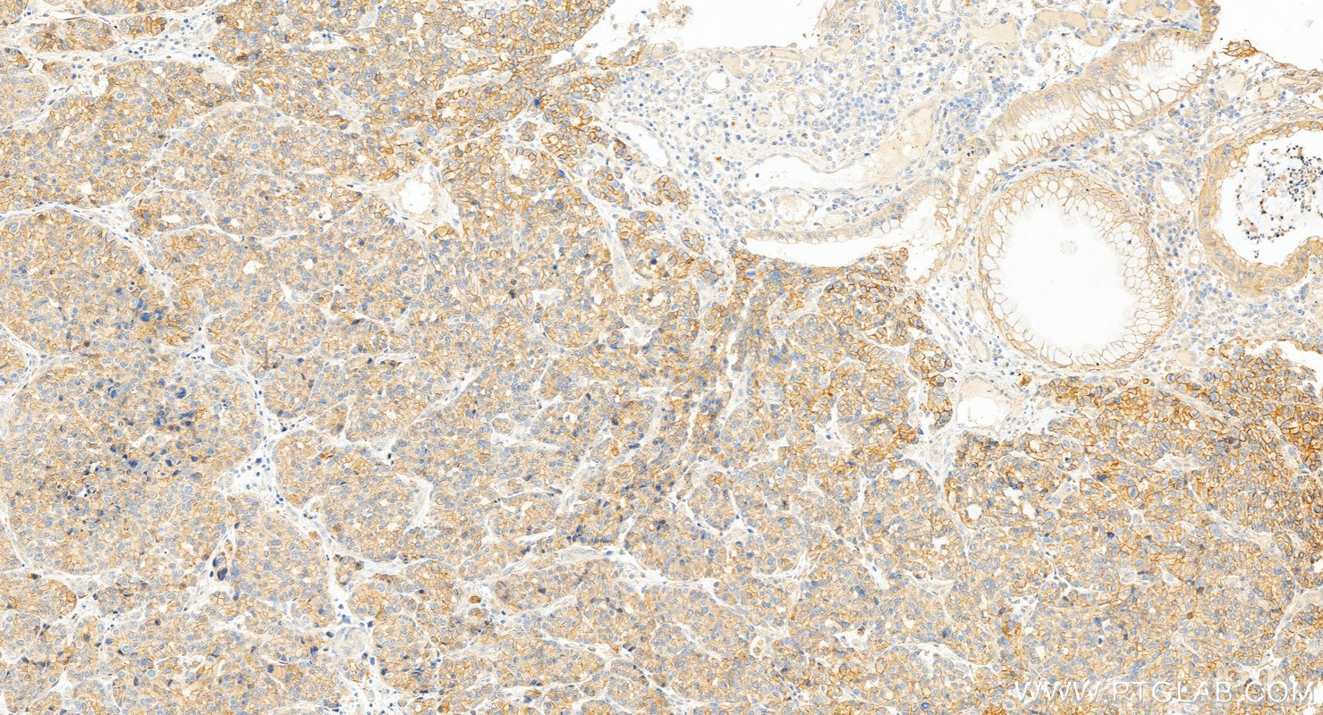Immunohistochemistry (IHC) staining of human stomach cancer tissue using EEPD1 Polyclonal antibody (24310-1-AP)