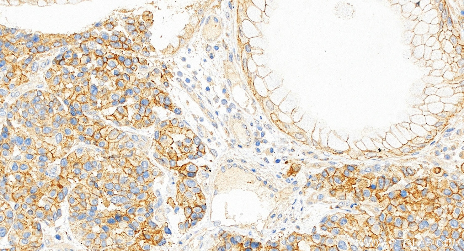 Immunohistochemistry (IHC) staining of human stomach cancer tissue using EEPD1 Polyclonal antibody (24310-1-AP)