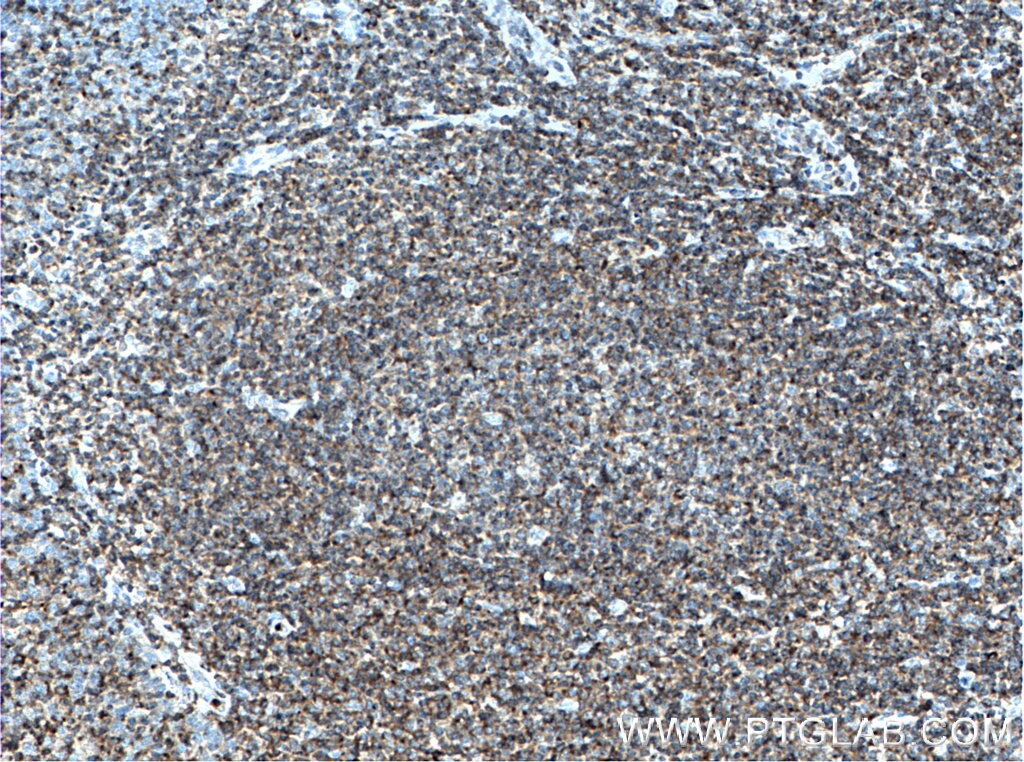 Immunohistochemistry (IHC) staining of human tonsillitis tissue using CRACR2A Polyclonal antibody (15206-1-AP)