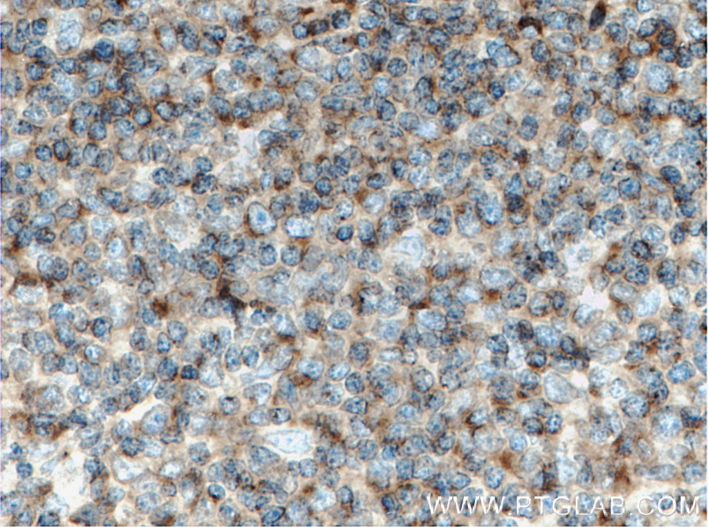 Immunohistochemistry (IHC) staining of human tonsillitis tissue using CRACR2A Polyclonal antibody (15206-1-AP)