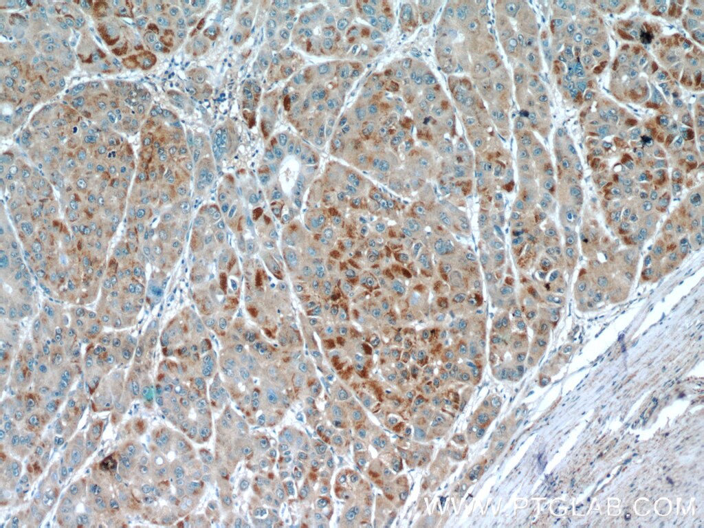 Immunohistochemistry (IHC) staining of human liver cancer tissue using EFCAB5 Polyclonal antibody (24296-1-AP)