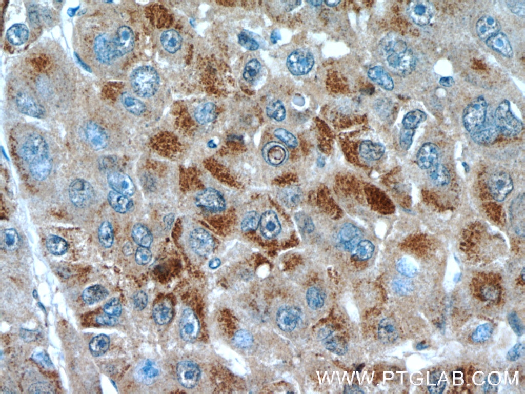 Immunohistochemistry (IHC) staining of human liver cancer tissue using EFCAB5 Polyclonal antibody (24296-1-AP)