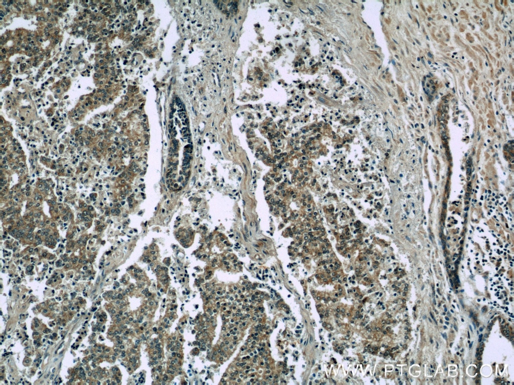 Immunohistochemistry (IHC) staining of human prostate cancer tissue using EFEMP2 Polyclonal antibody (12004-1-AP)