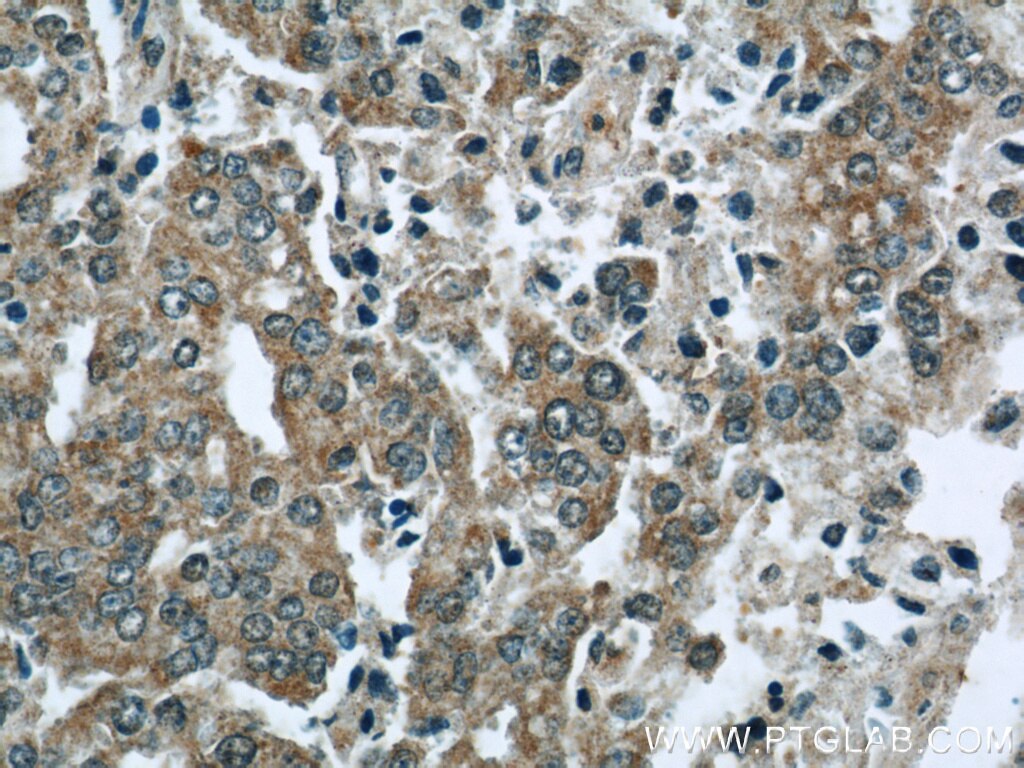 Immunohistochemistry (IHC) staining of human prostate cancer tissue using EFEMP2 Polyclonal antibody (12004-1-AP)