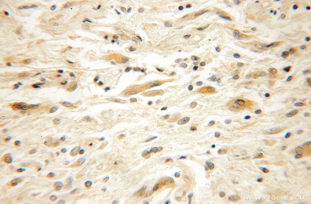 IHC staining of human medulloblastoma using 12181-1-AP