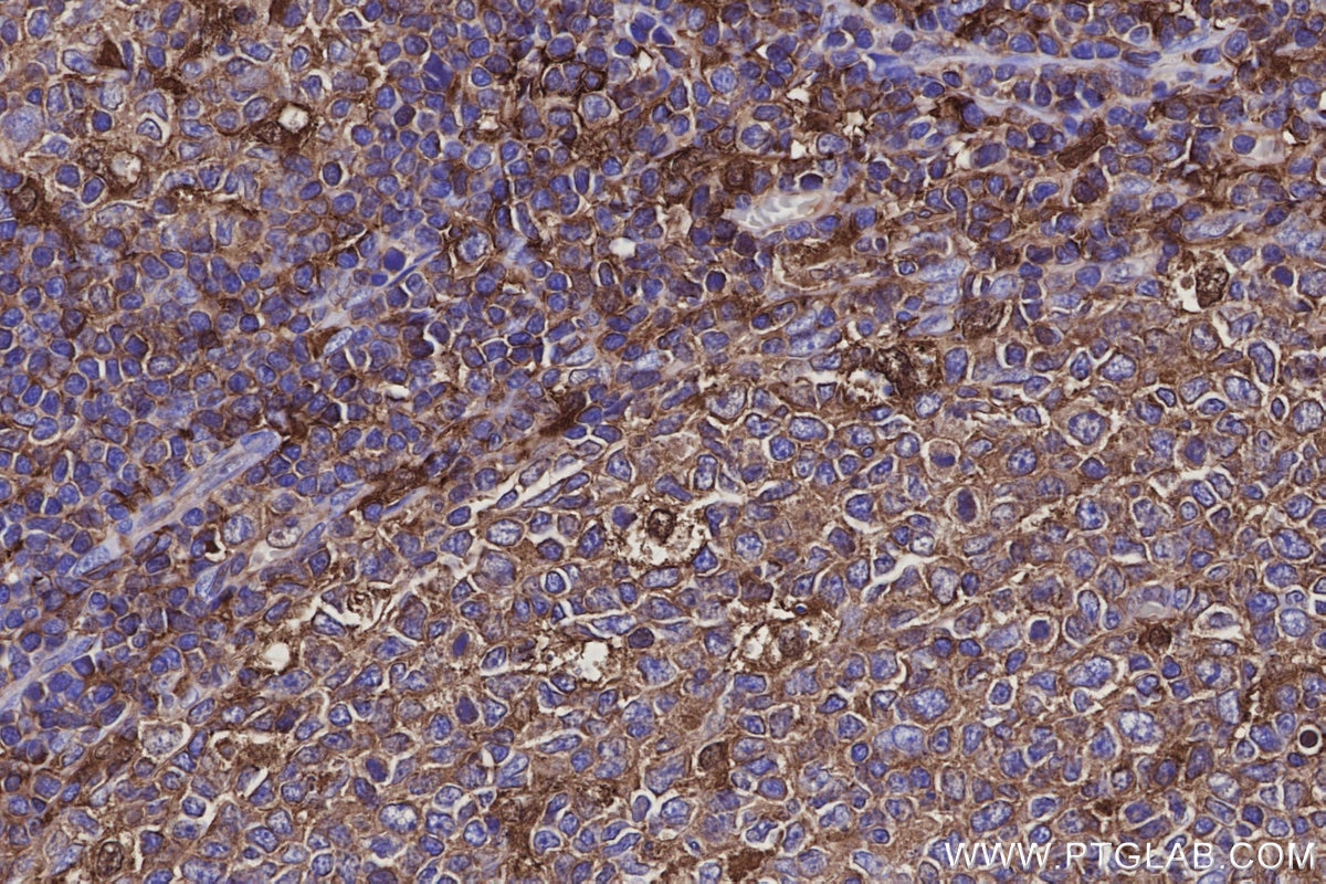 IHC staining of human tonsillitis using 83264-5-RR Immunohistochemistry (IHC) staining of human tonsillitis tissue using EFHD2 Recombinant monoclonal antibody (83264-5-RR)