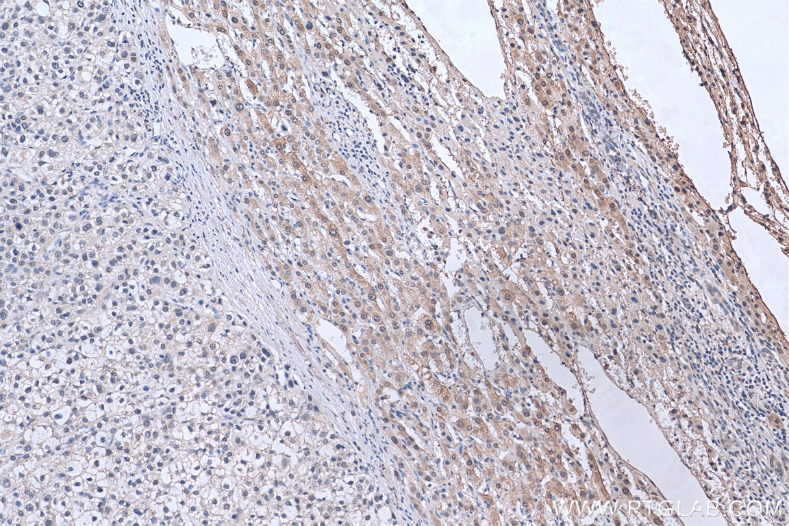 Immunohistochemistry (IHC) staining of human liver cancer tissue using EFTUD2 Monoclonal antibody (67855-1-Ig)