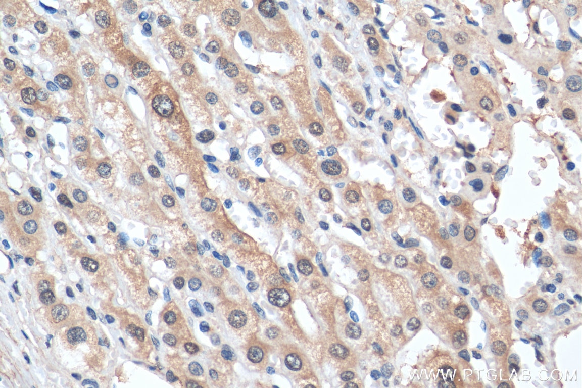 IHC staining of human liver cancer using 67855-1-Ig