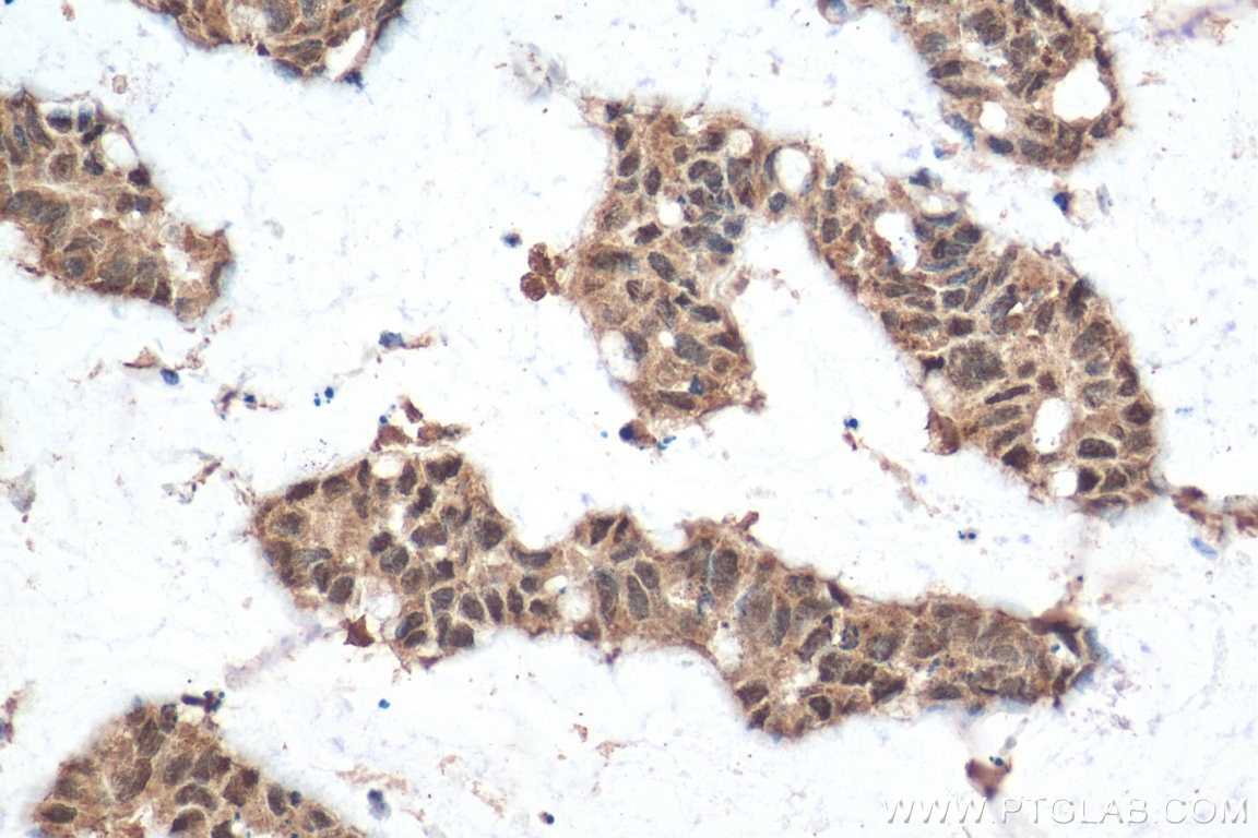 Immunohistochemistry (IHC) staining of human colon cancer tissue using EFTUD2 Monoclonal antibody (67855-1-Ig)