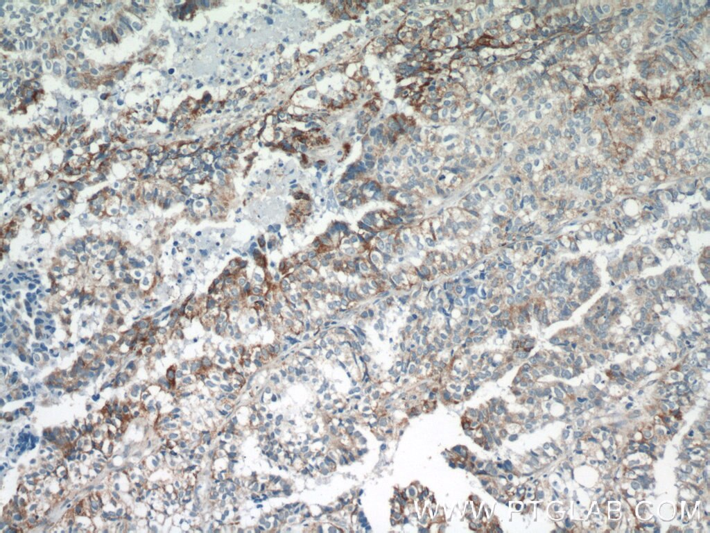 Immunohistochemistry (IHC) staining of human breast cancer tissue using EGFL7 Polyclonal antibody (19291-1-AP)