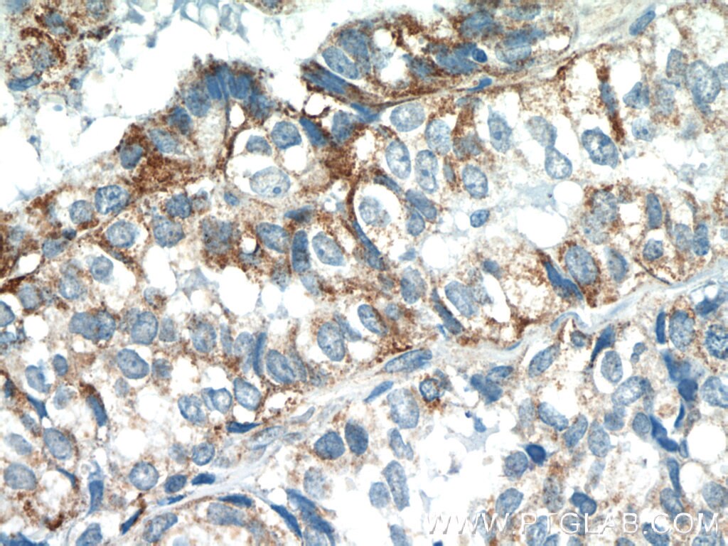 Immunohistochemistry (IHC) staining of human breast cancer tissue using EGFL7 Polyclonal antibody (19291-1-AP)