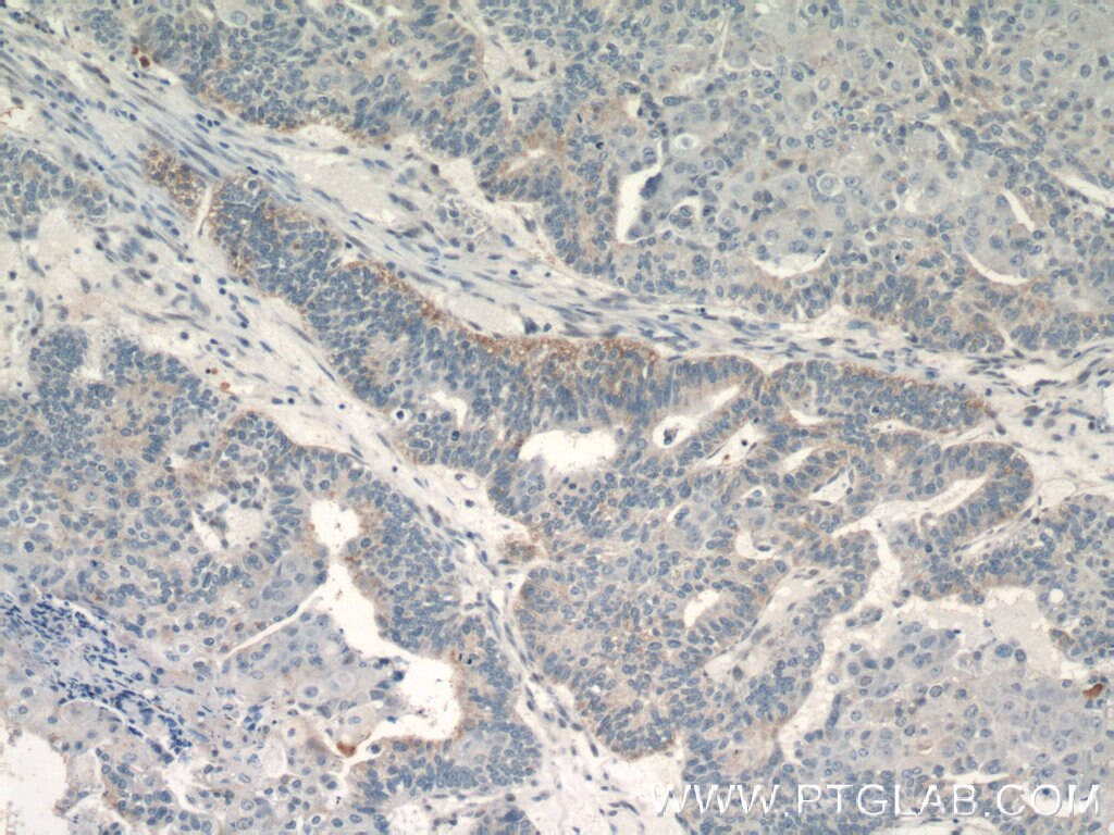 Immunohistochemistry (IHC) staining of human ovary tumor tissue using EGFL7 Polyclonal antibody (19291-1-AP)