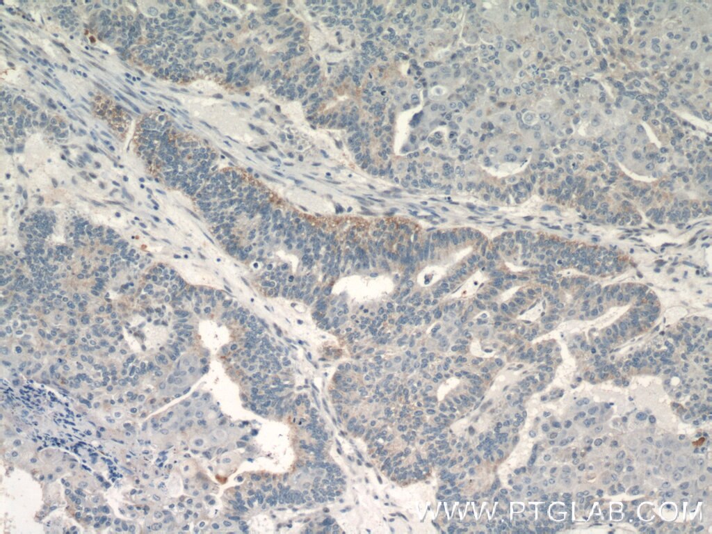 IHC staining of human ovary tumor using 19291-1-AP