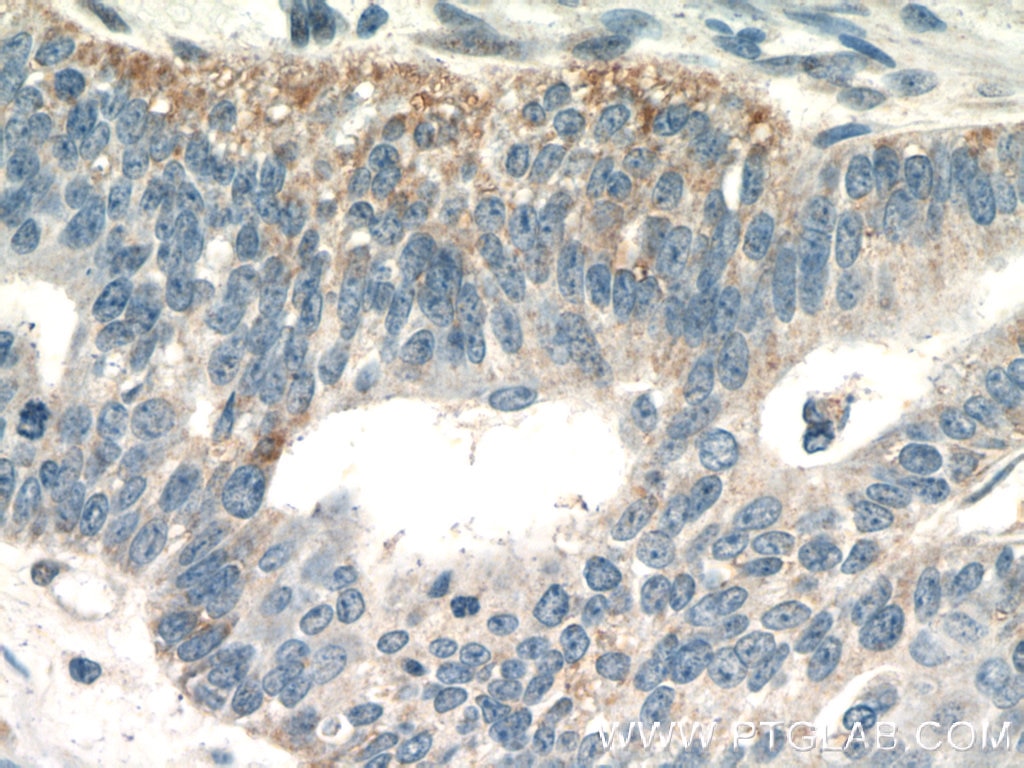 Immunohistochemistry (IHC) staining of human ovary tumor tissue using EGFL7 Polyclonal antibody (19291-1-AP)
