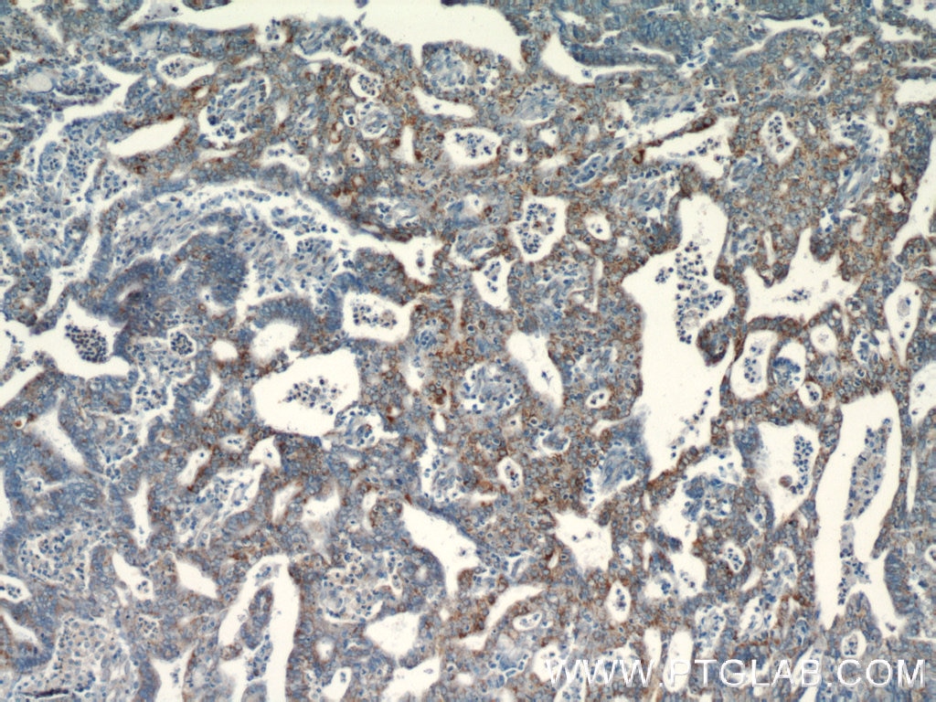 IHC staining of human endometrial cancer using 19291-1-AP