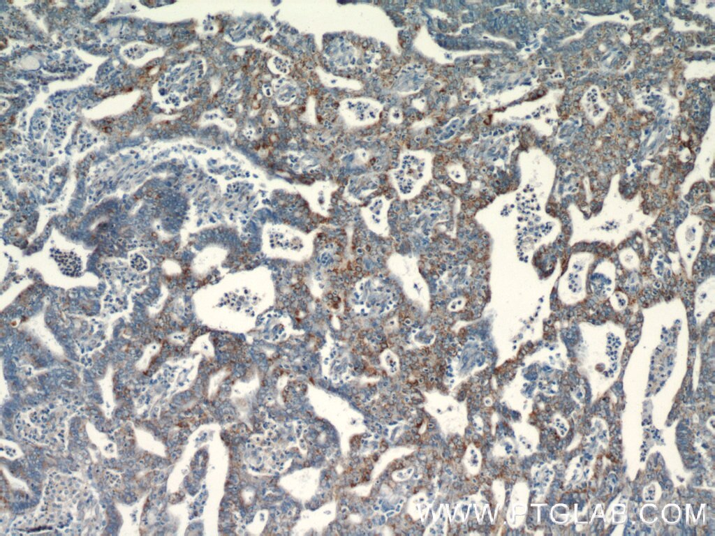 Immunohistochemistry (IHC) staining of human endometrial cancer tissue using EGFL7 Polyclonal antibody (19291-1-AP)