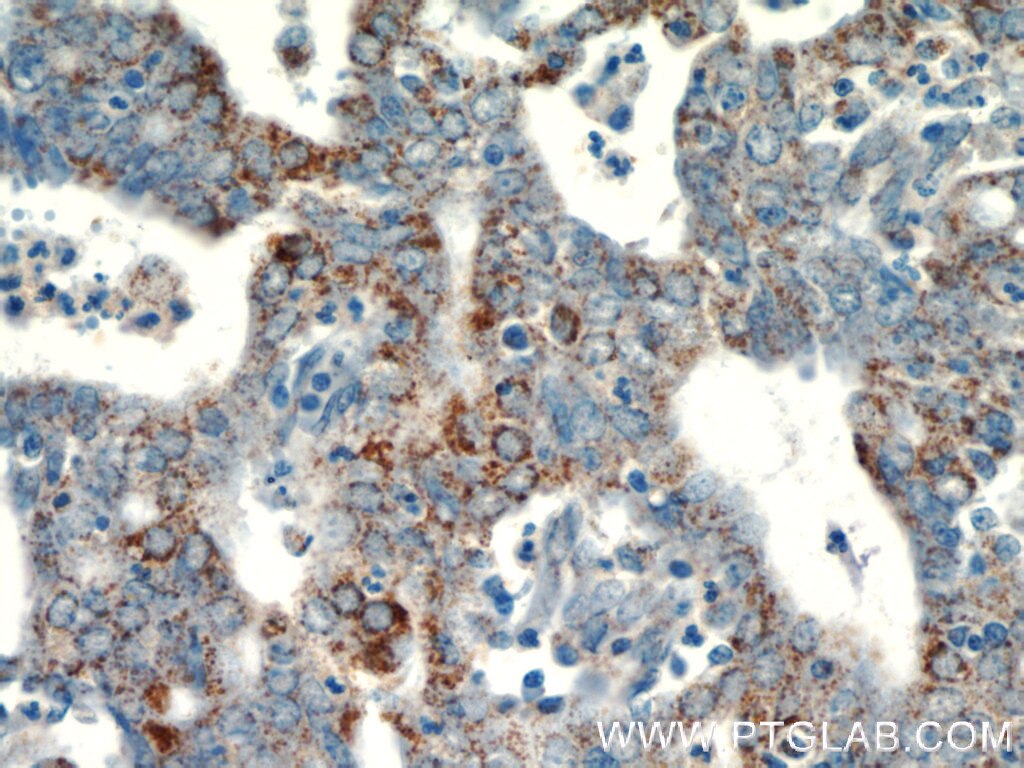 Immunohistochemistry (IHC) staining of human endometrial cancer tissue using EGFL7 Polyclonal antibody (19291-1-AP)