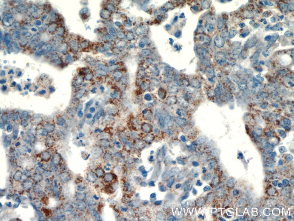 IHC staining of human endometrial cancer using 19291-1-AP