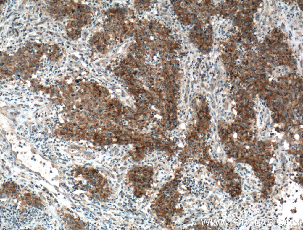 Immunohistochemistry (IHC) staining of human colon cancer tissue using EGFR Monoclonal antibody (66455-1-Ig)