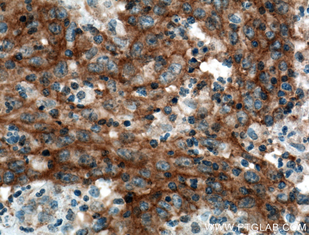 Immunohistochemistry (IHC) staining of human colon cancer tissue using EGFR Monoclonal antibody (66455-1-Ig)