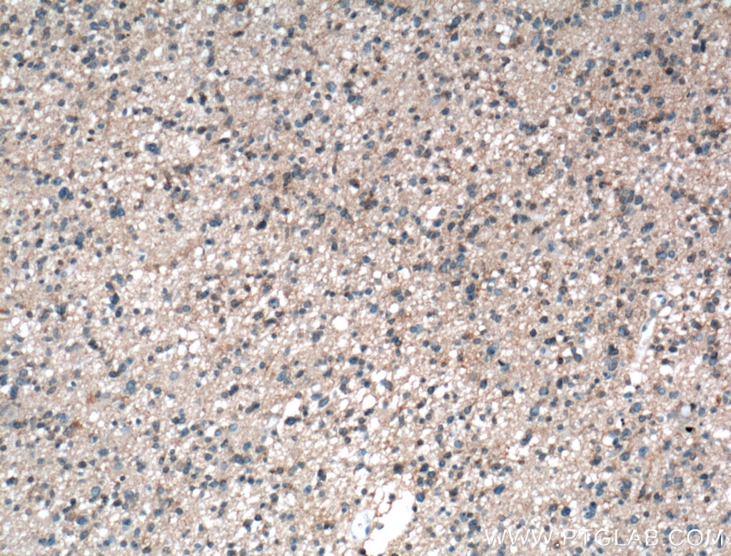 IHC staining of human gliomas using 66455-1-Ig