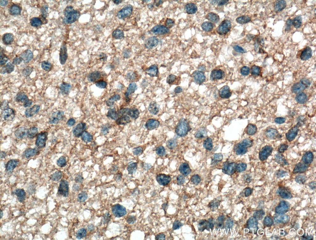 Immunohistochemistry (IHC) staining of human gliomas tissue using EGFR Monoclonal antibody (66455-1-Ig)