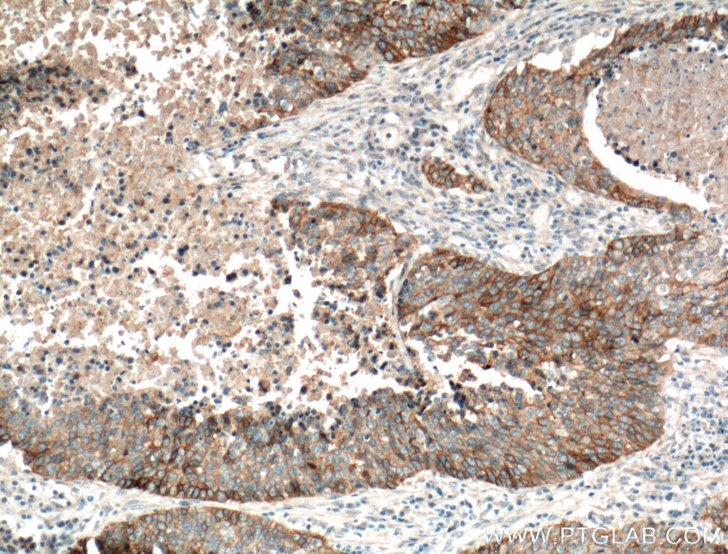 Immunohistochemistry (IHC) staining of human lung cancer tissue using EGFR Monoclonal antibody (66455-1-Ig)