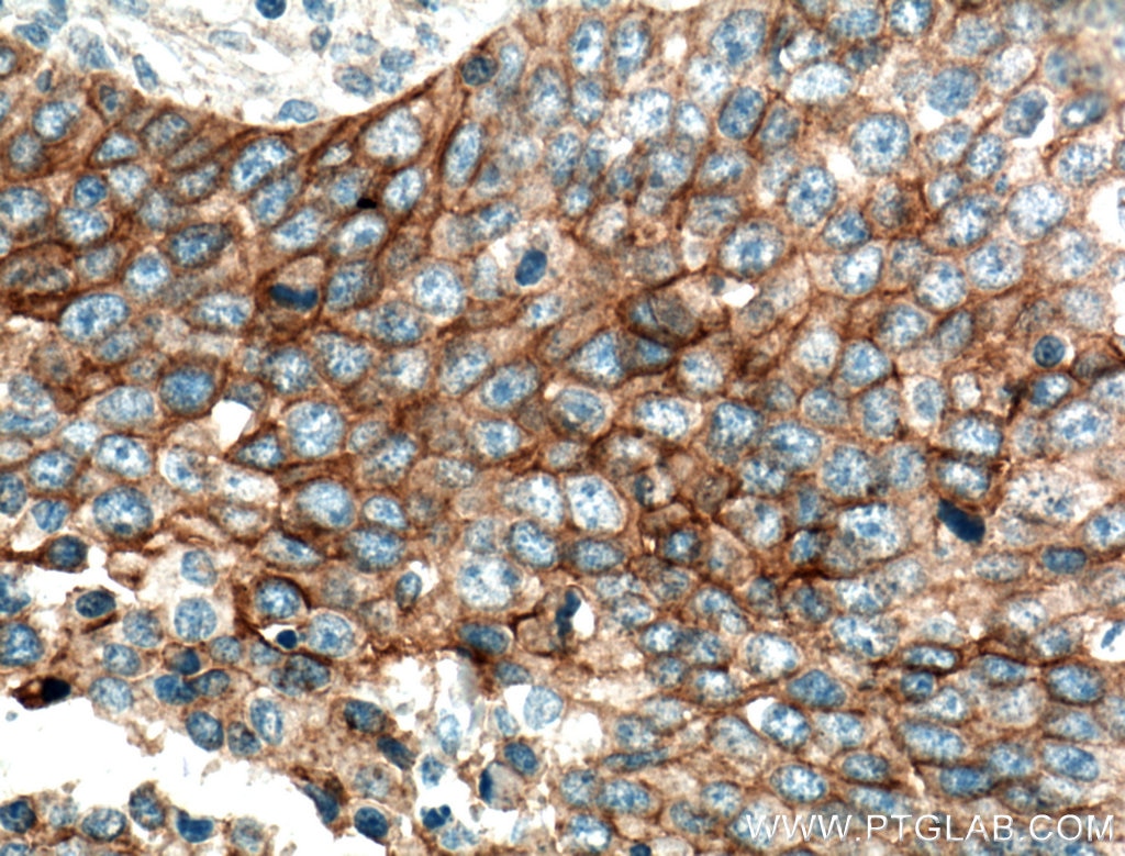 Immunohistochemistry (IHC) staining of human lung cancer tissue using EGFR Monoclonal antibody (66455-1-Ig)