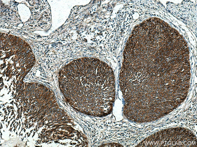 Immunohistochemistry (IHC) staining of human cervical cancer tissue using EGFR Monoclonal antibody (66455-1-Ig)
