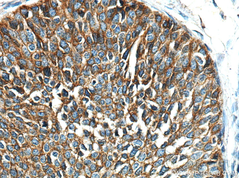 Immunohistochemistry (IHC) staining of human cervical cancer tissue using EGFR Monoclonal antibody (66455-1-Ig)