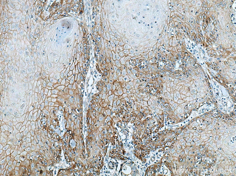 Immunohistochemistry (IHC) staining of human skin cancer tissue using EGFR Monoclonal antibody (66455-1-Ig)