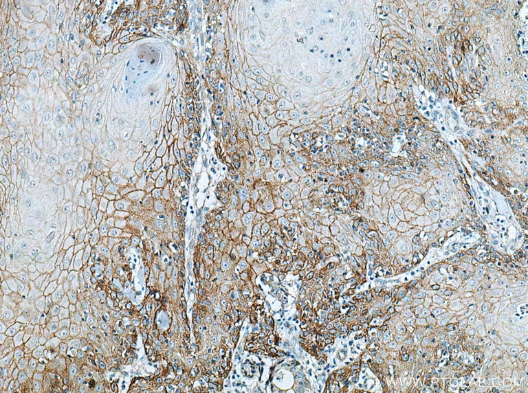 IHC staining of human skin cancer using 66455-1-Ig