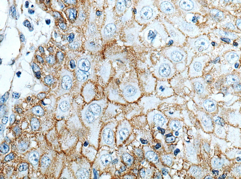 Immunohistochemistry (IHC) staining of human skin cancer tissue using EGFR Monoclonal antibody (66455-1-Ig)