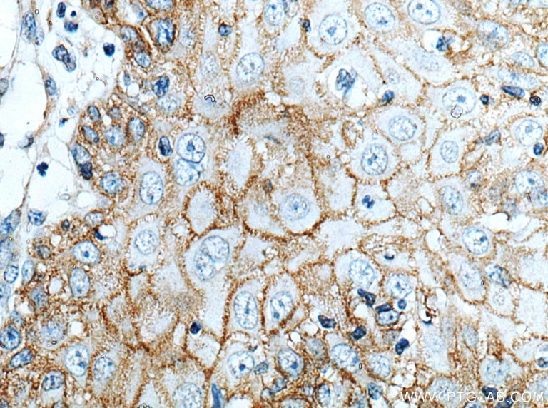 IHC staining of human skin cancer using 66455-1-Ig