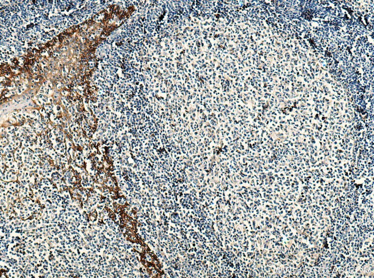 IHC staining of human tonsillitis using 66455-1-Ig