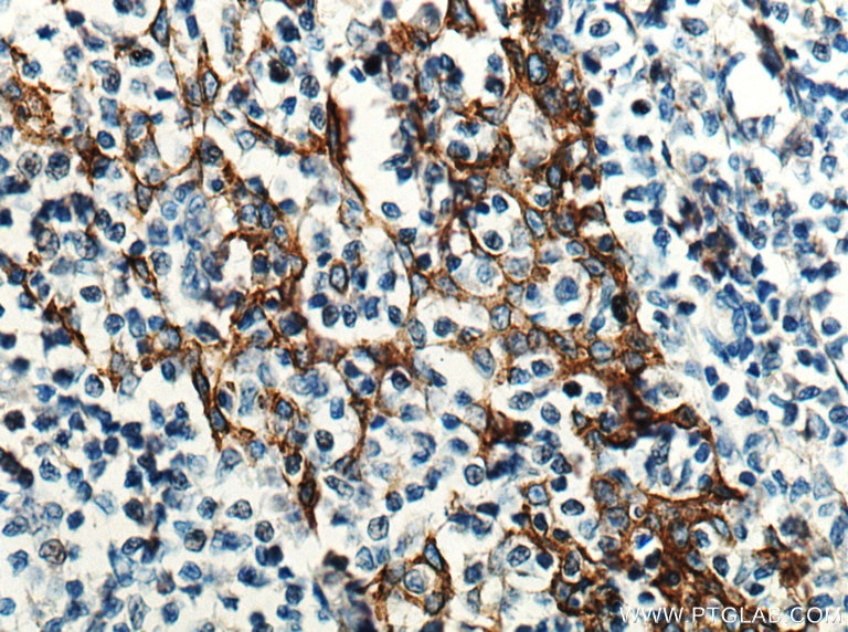 Immunohistochemistry (IHC) staining of human tonsillitis tissue using EGFR Monoclonal antibody (66455-1-Ig)
