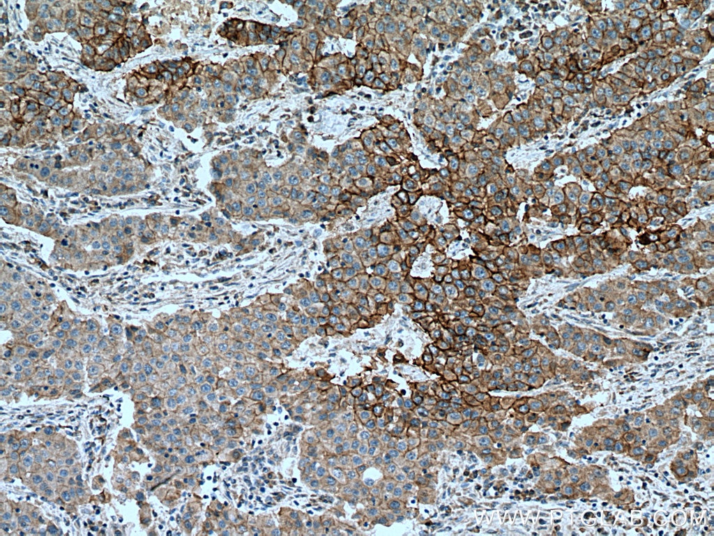 Immunohistochemistry (IHC) staining of human breast cancer tissue using EGFR Monoclonal antibody (66455-1-Ig)