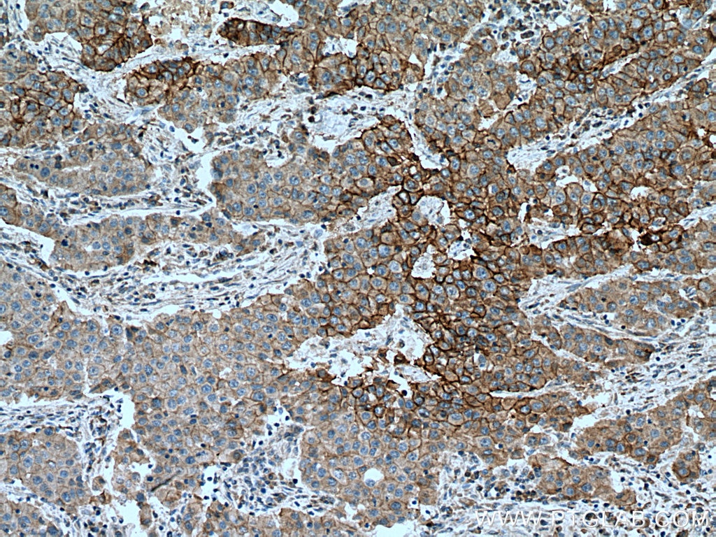 IHC staining of human breast cancer using 66455-1-Ig