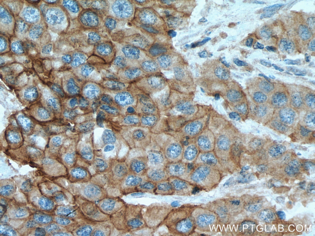 Immunohistochemistry (IHC) staining of human breast cancer tissue using EGFR Monoclonal antibody (66455-1-Ig)