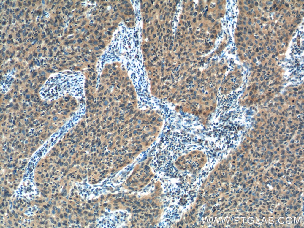 Immunohistochemistry (IHC) staining of human cervical cancer tissue using EGFR-Specific Polyclonal antibody (18986-1-AP)
