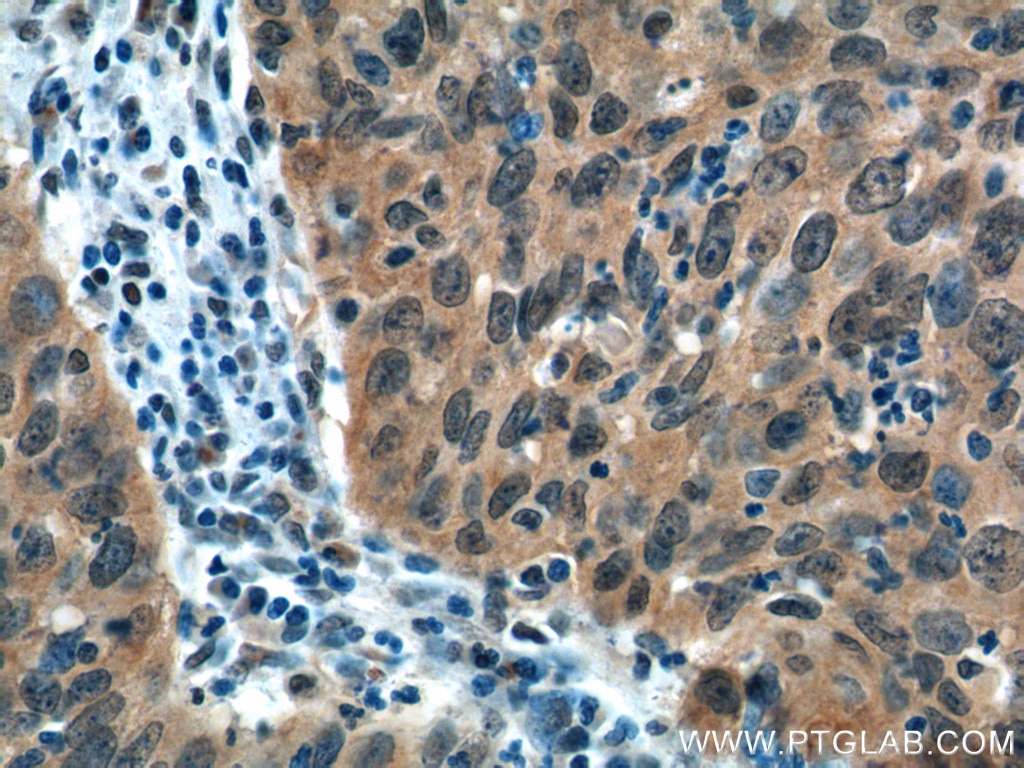 Immunohistochemistry (IHC) staining of human cervical cancer tissue using EGFR-Specific Polyclonal antibody (18986-1-AP)