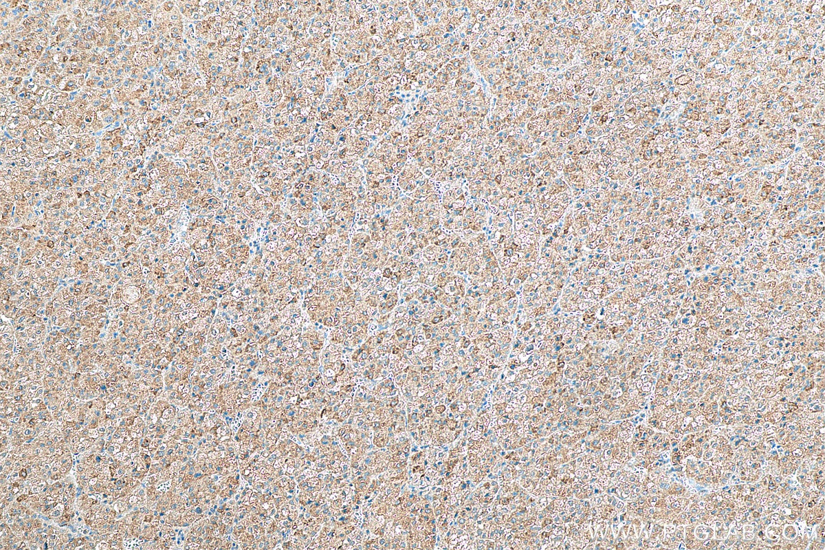 IHC staining of human liver cancer using 19886-1-AP