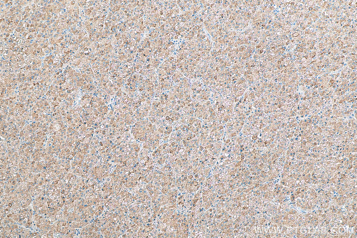 Immunohistochemistry (IHC) staining of human liver cancer tissue using PHD2/EGLN1 Polyclonal antibody (19886-1-AP)