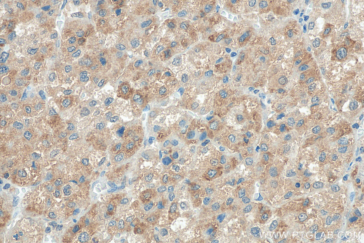 Immunohistochemistry (IHC) staining of human liver cancer tissue using PHD2/EGLN1 Polyclonal antibody (19886-1-AP)