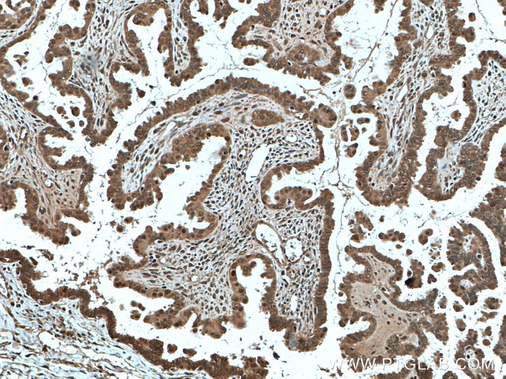 Immunohistochemistry (IHC) staining of human ovary tumor tissue using EGR1 Polyclonal antibody (22008-1-AP)